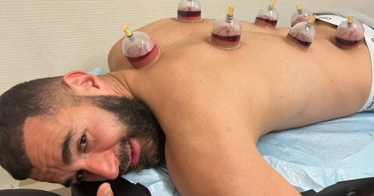 Qu es la terapia con ventosas el tratamiento con el que se