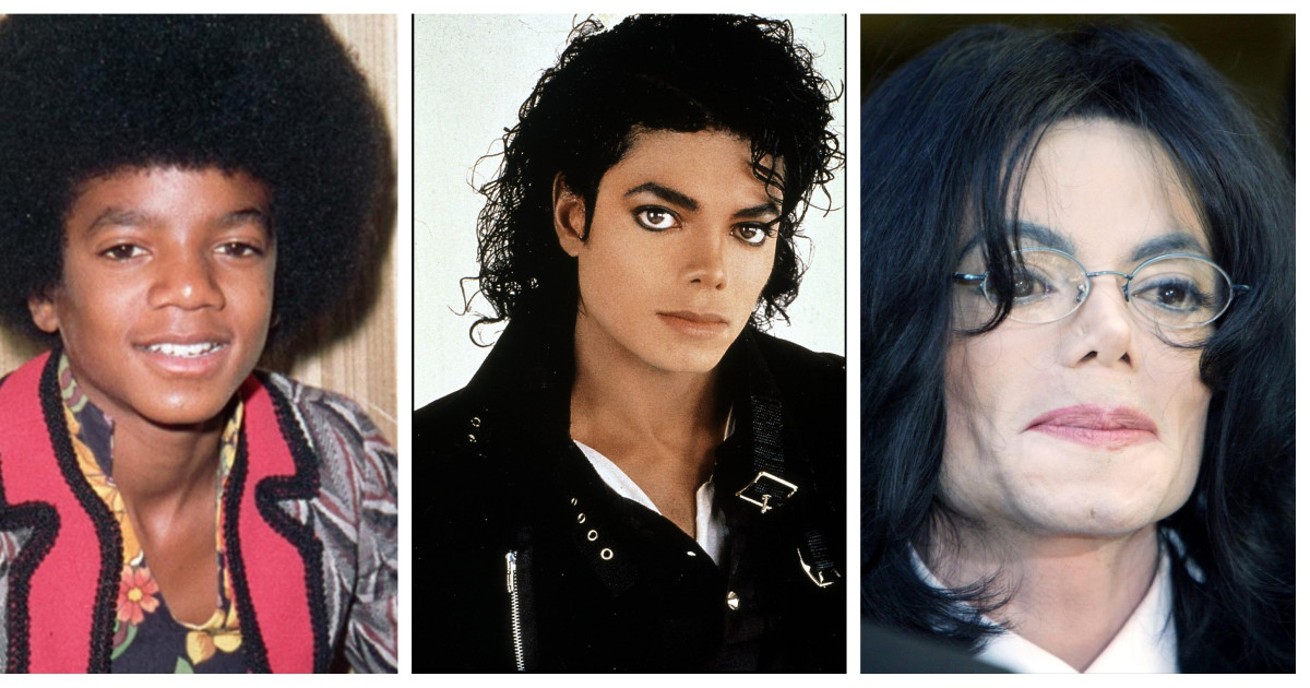 Vitíligo, la enfermedad de la piel que sufría Michael Jackson