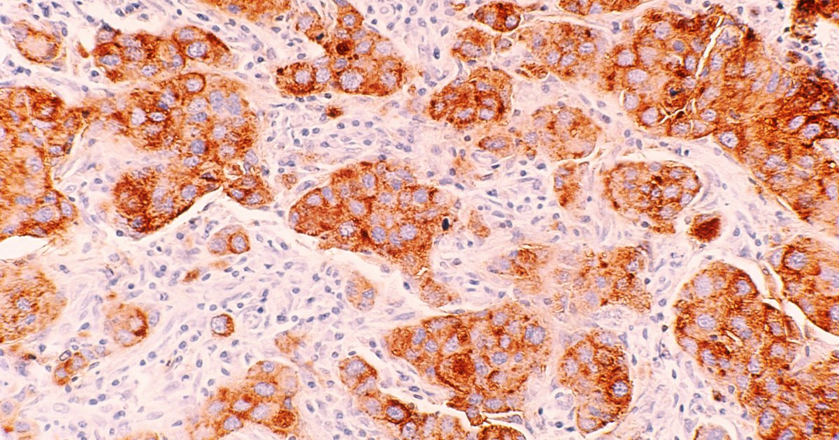 研究者グループが乳がんの原因の可能性を発見